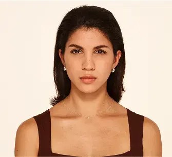 After Botox treatment for frown lines
