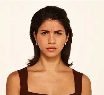 Before Botox treatment for frown lines