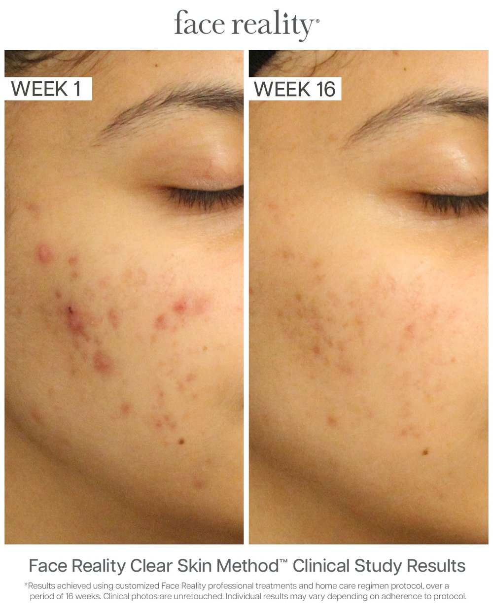 Face Reality Clear Skin Method before and after results, week 1 to week 16, inflammatory acne