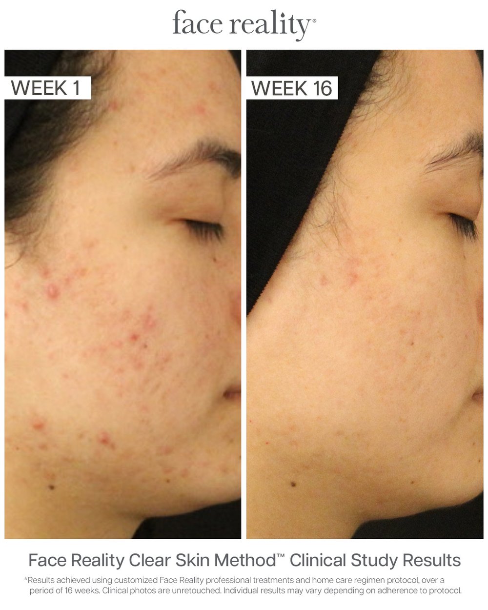 Face Reality Clear Skin Method before and after results, week 1 to week 16, cystic and congested acne