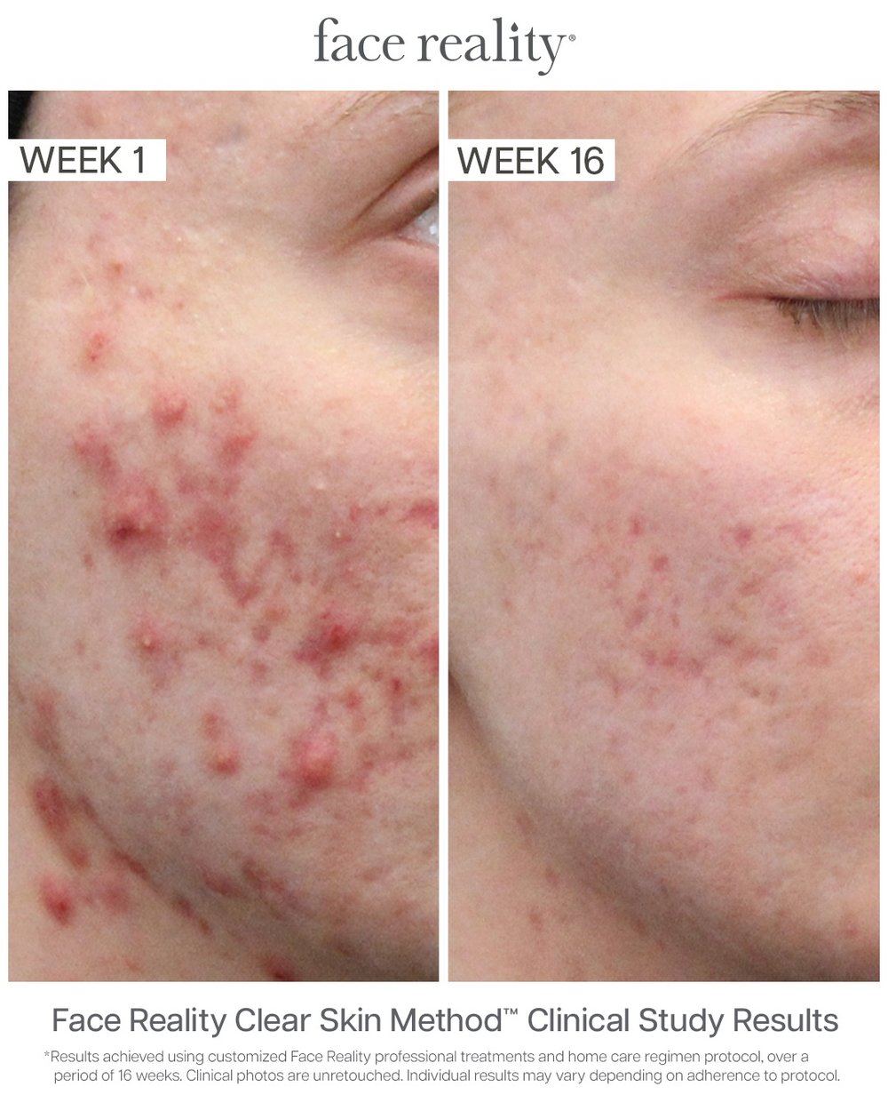Face Reality Clear Skin Method before and after results, week 1 to week 16, textural and post-acne marks