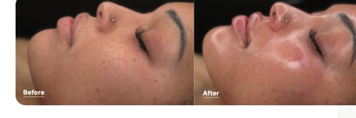 Before and after a HydraFacial treatment showing visible improvement in skin hydration and plumpness