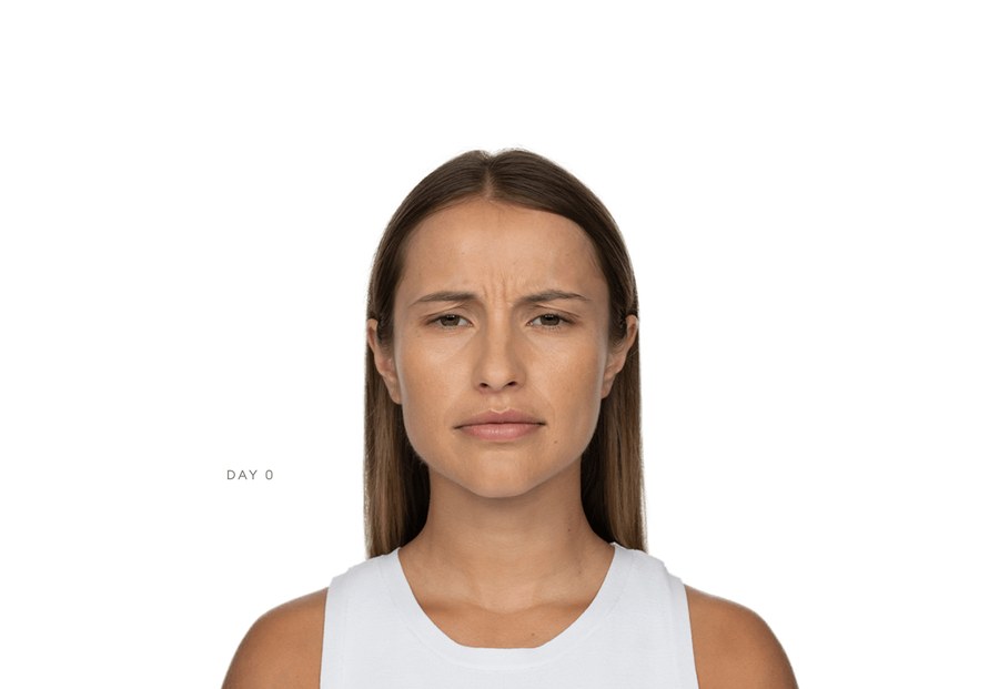 Jeuveau patient Arielle at Day 0, before treatment