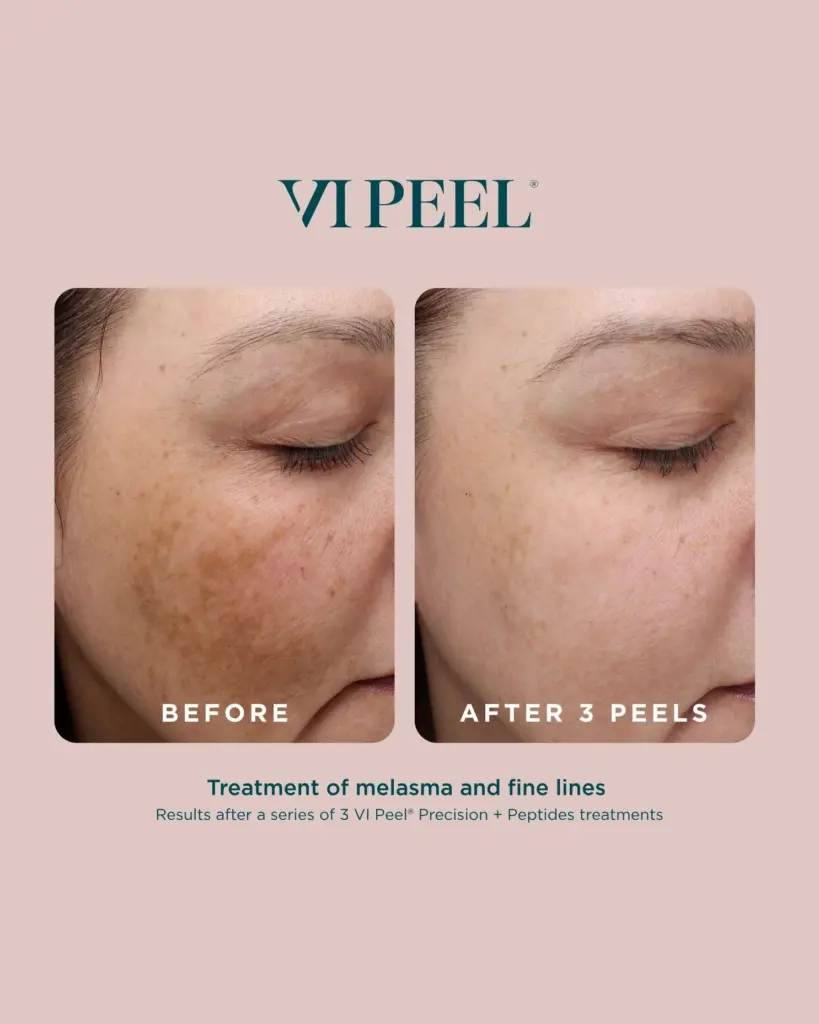 Before and After VI Peel® in Hamilton, NJ