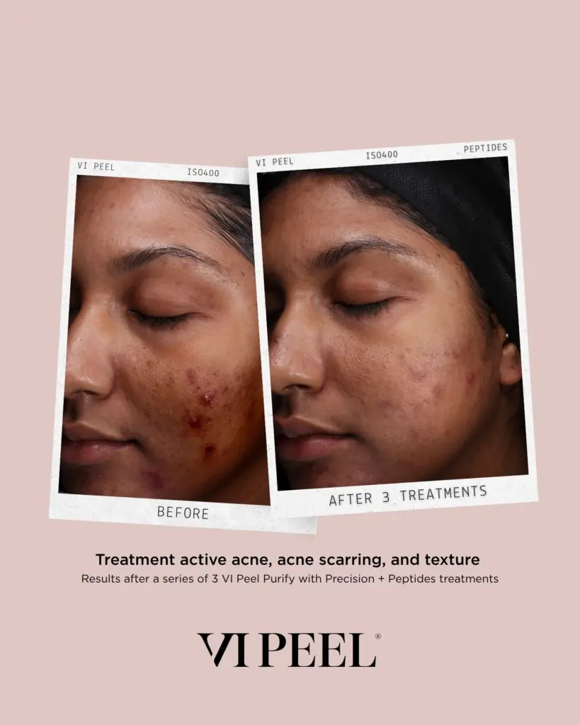 VI Peel® in Hamilton, NJ